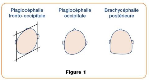 3 types de plagiocéphalie par émanea