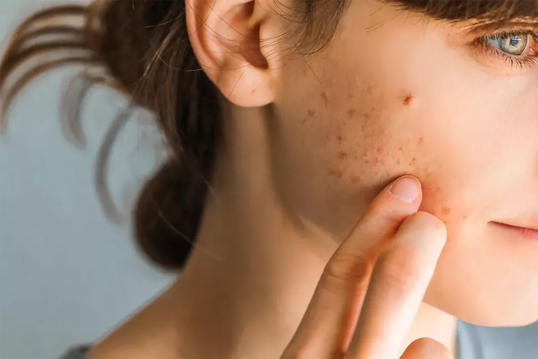Adolescente touchant une zone d’acné sur sa joue.